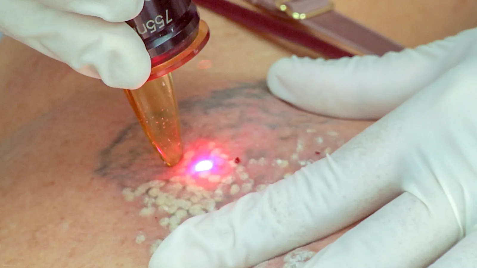 Detalle del tratamiento: el láser actúa sobre las líneas del tatuaje. La tinta fragmentada se elimina después de forma natural por el organismo, a lo largo de varias sesiones.