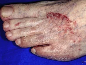 Pie de atleta (tinea pedis): descamación, enrojecimiento y grietas, típicamente entre los dedos.