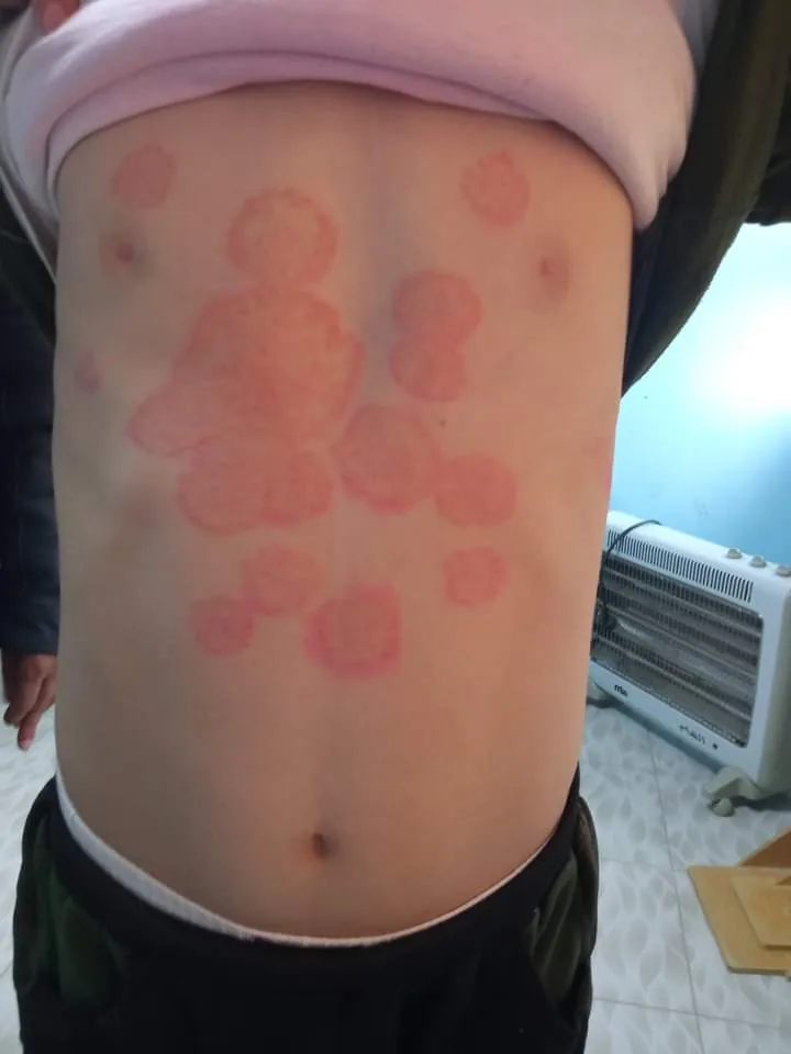 Tiña del cuerpo (tinea corporis): placa circular con borde rojo elevado y centro más claro.