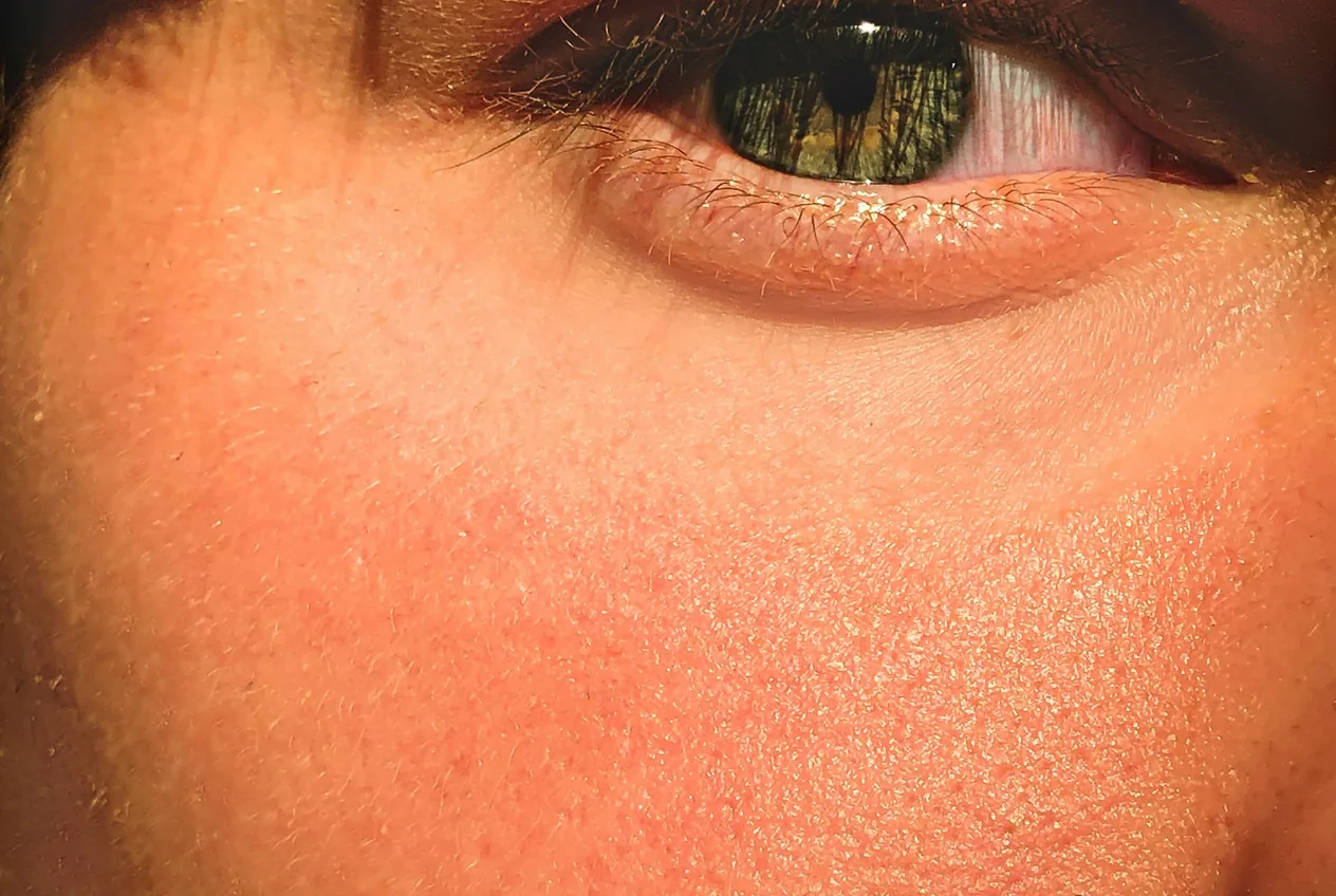 Poches sous les yeux