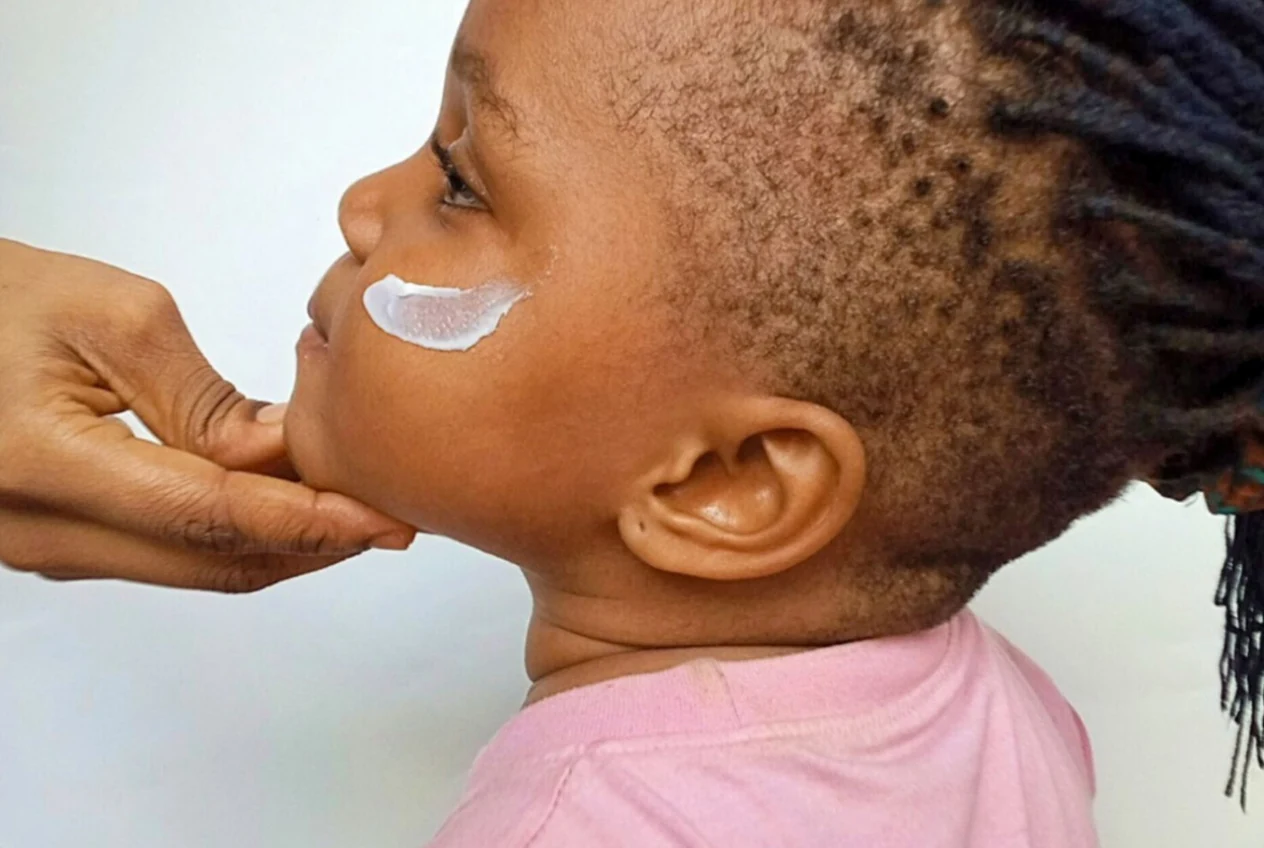 Dermatitis atópica infantil