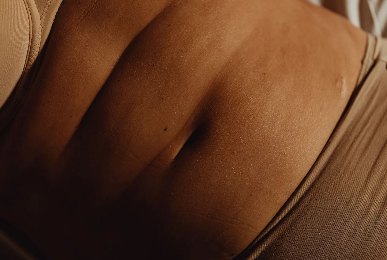 Stretch marks