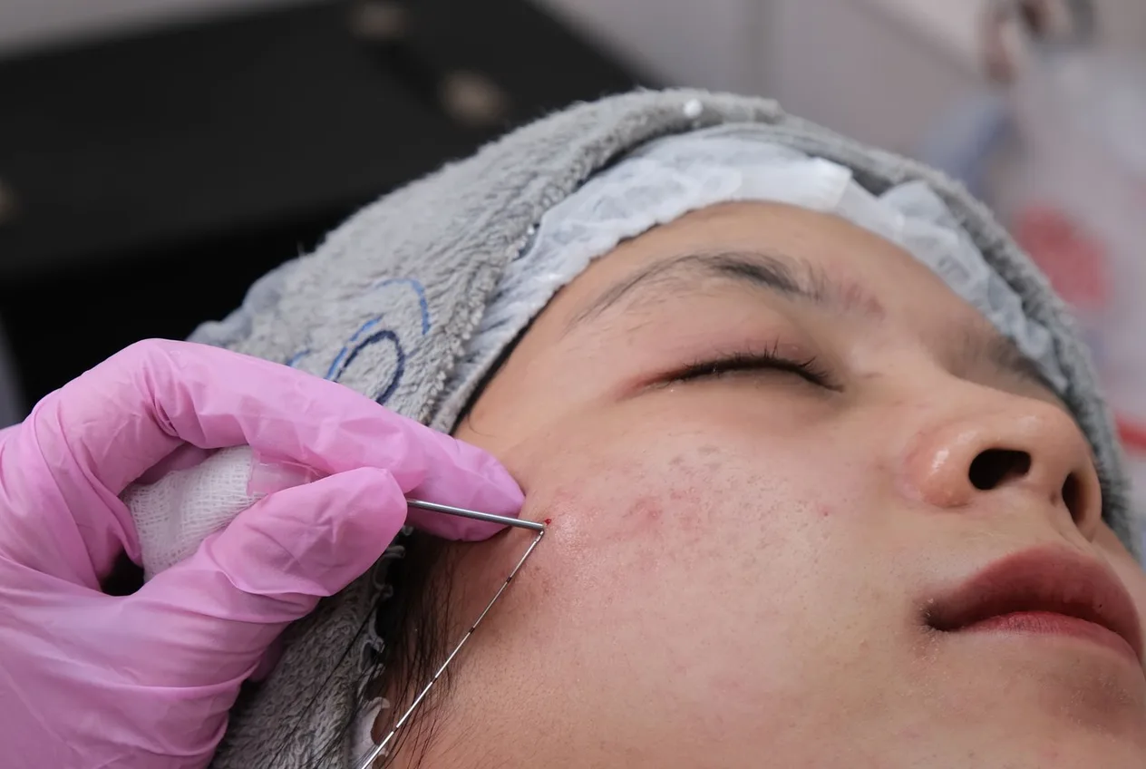 Microneedling
