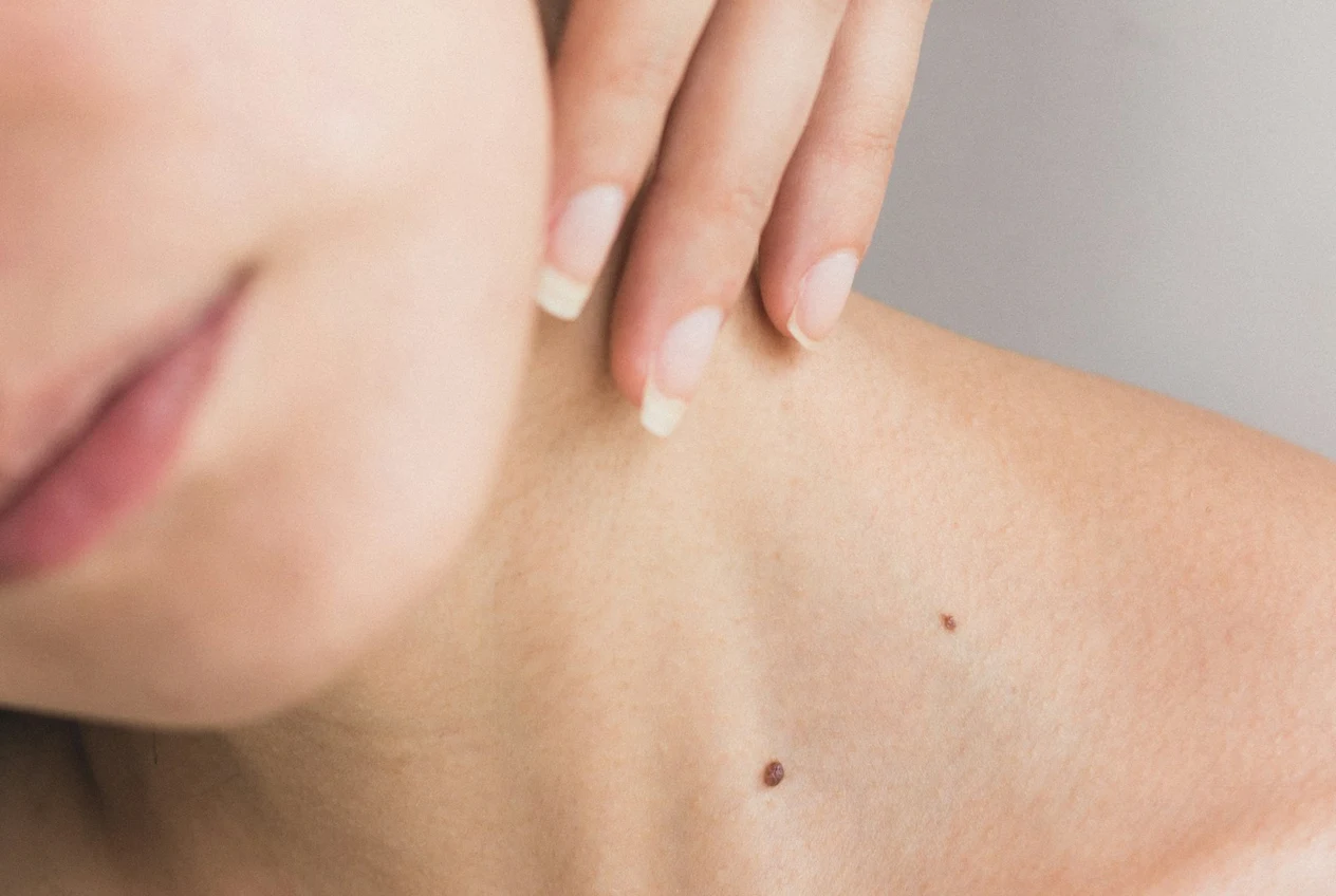 Everything about rosacea: causes, symptoms, treatments and care to control the disease