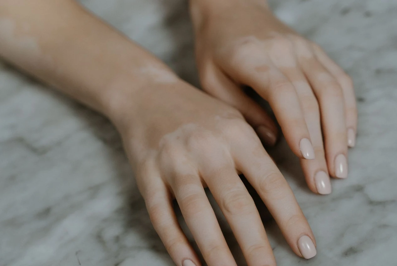 Everything about vitiligo: causes, symptoms, diagnosis and current treatments